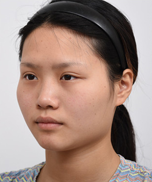 北京李炳浍做鼻子技术反馈怎么样？