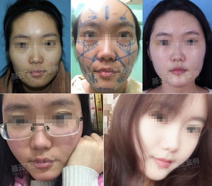 聂云飞教授做脂肪填充效果好吗？