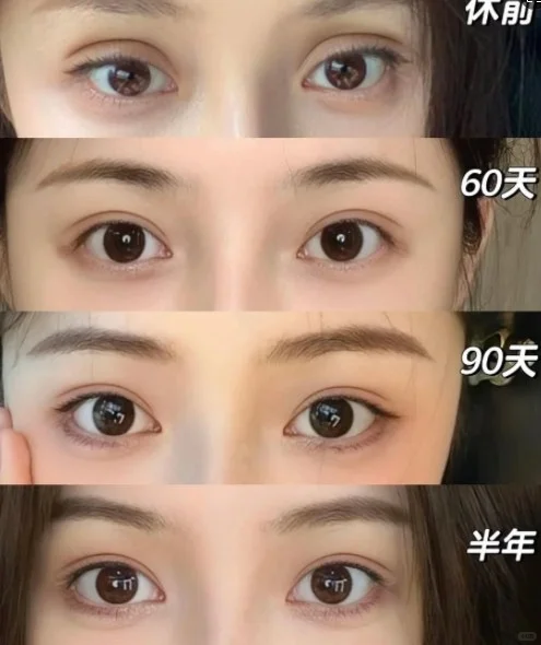 厦门双眼皮修复专家陈运生和张宏哪个医生做眼修复做的好？