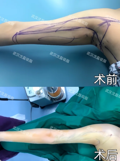 2026年武汉吸脂预约咨询前五名排行榜：朱继锋、陈克、沈磊、包涛、杨杰做吸脂谁口碑最好？