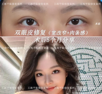 武汉双眼皮修复王海平和方涛哪个修复效果好？王海平和方涛做眼修复预约电话咨询