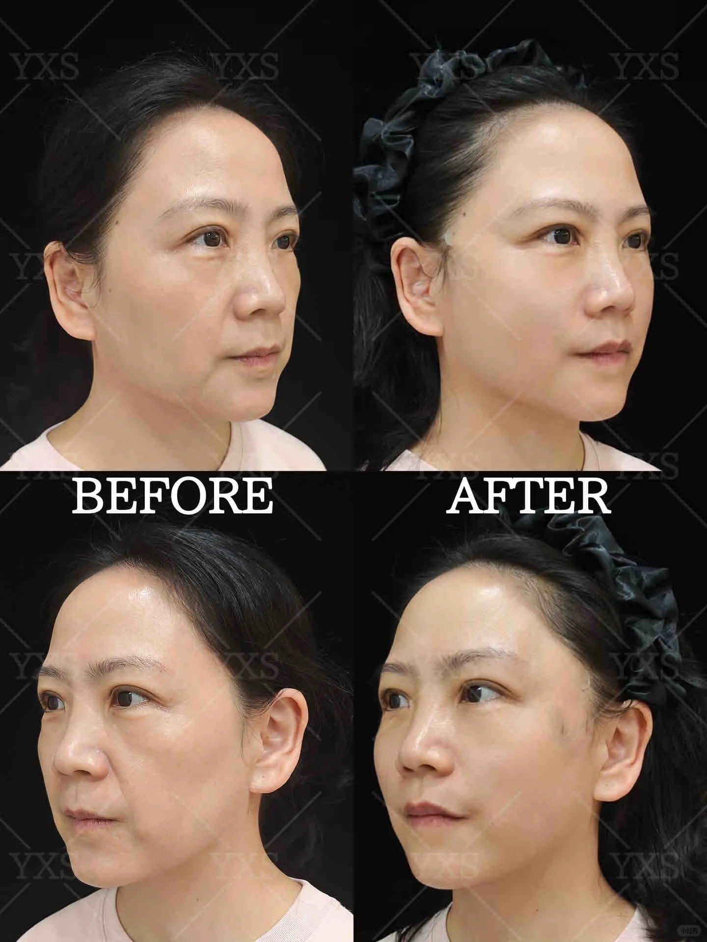 深圳面部年轻化专家高志文和王乙立做面部提升哪个技术好？保持时间久？