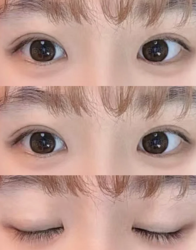 深圳双眼皮修复专家向萌娟和王志东哪个医生眼修复技术好？