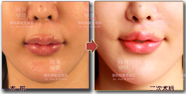 国内人中缩短哪个医生做得好？潘柏林和刘玉辉谁好？