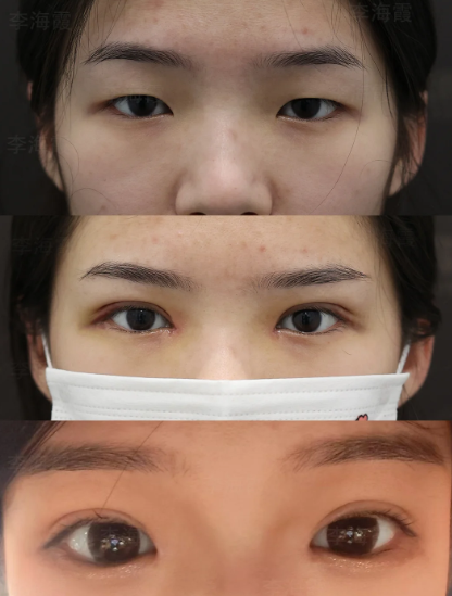 石家庄李海霞和郝俊哪个医生双眼皮技术好？李海霞和郝俊做双眼皮预约电话