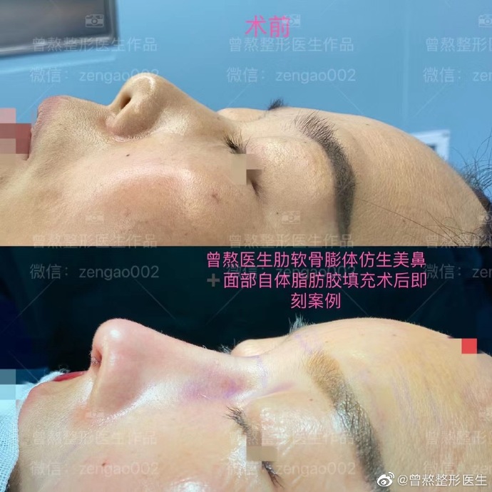 西安曾熬做鼻子怎么样，曾熬隆鼻技术靠谱吗？