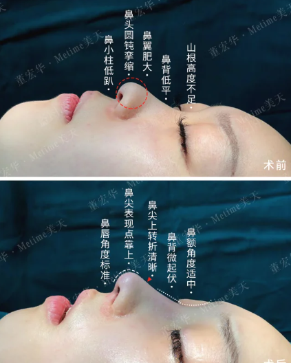 石家庄做鼻子董宏华和苏晓光哪个医生口碑好？董宏华和苏晓光隆鼻咨询预约电话