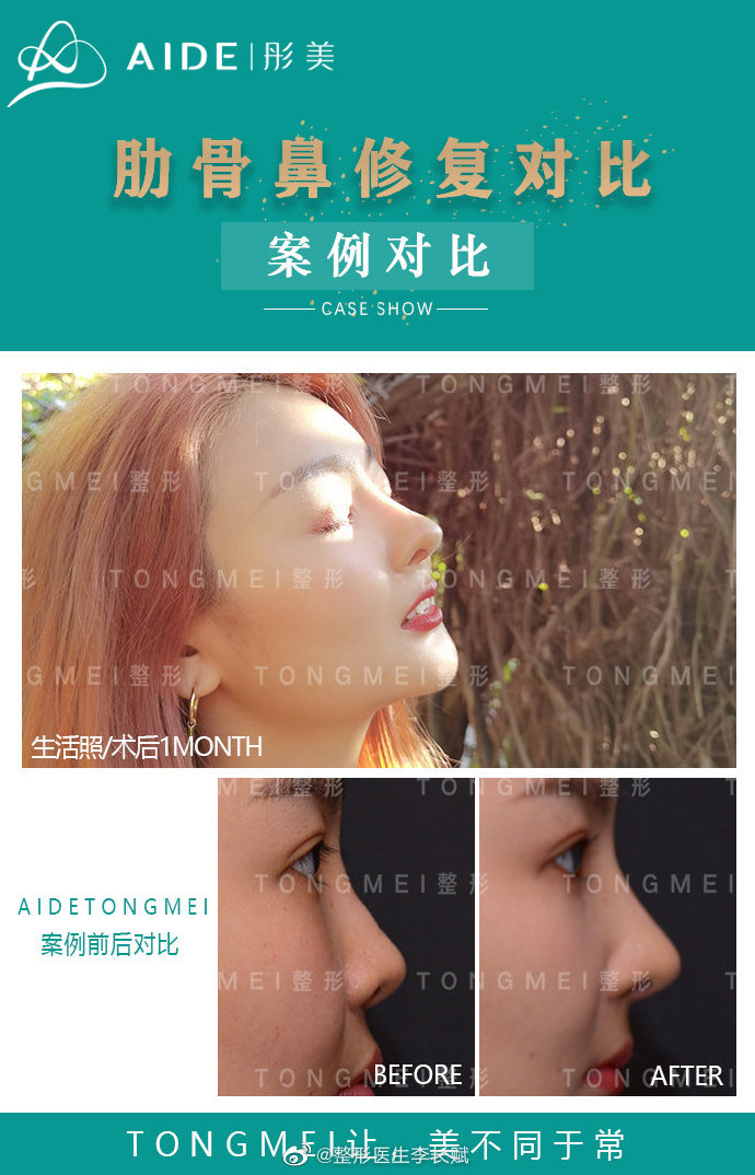 李长赋做疑难鼻修复技术怎么样？