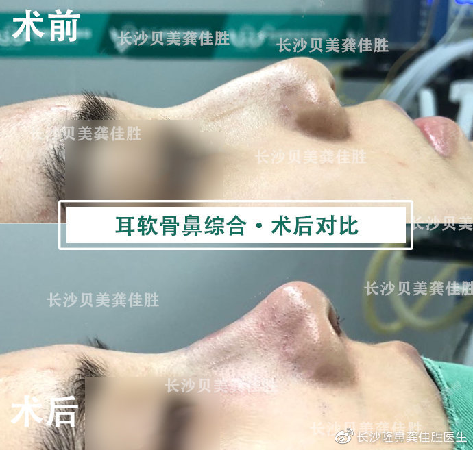 龚佳胜做鼻子技术好不好？