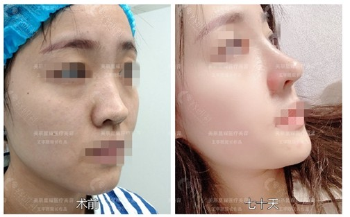 成都王宇琨做的鼻子技术怎么样？