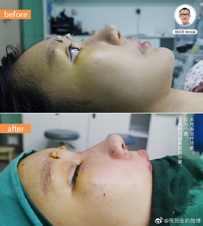 成都徐航肋和倪云志骨鼻修复技术谁好？