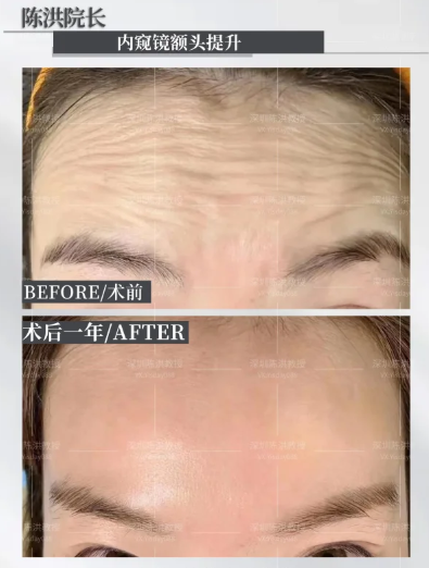 深圳面部拉皮专家陈洪和张陈威哪个医生技术好？陈洪和张陈威面部提升谁好？