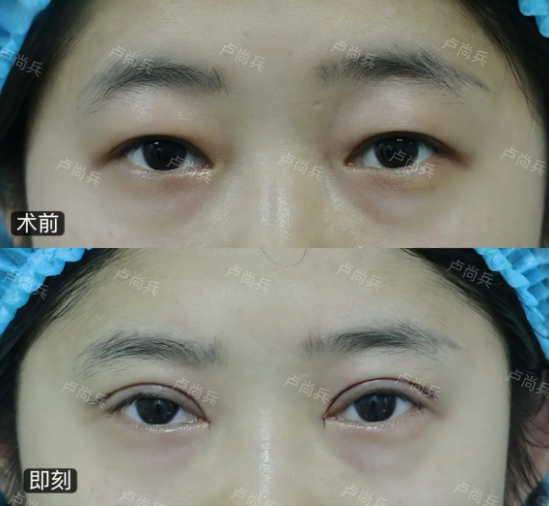 成都眼修复专家卢尚兵和高亮哪个医生做双眼皮修复好？卢尚兵和高亮眼修复预约