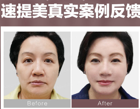 姚乃君面部提升技术怎么样，速提美提升价格？