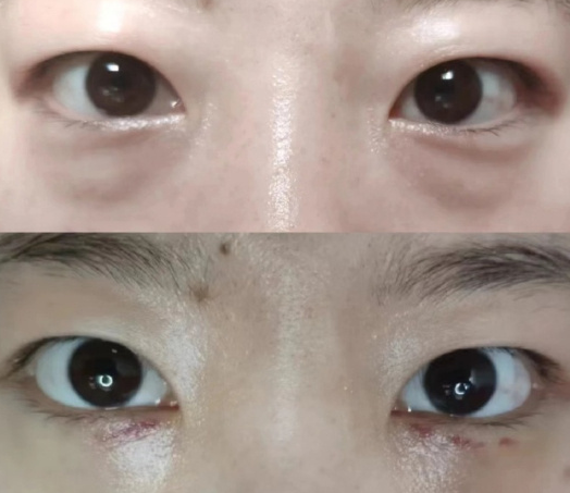 北京去眼袋专家卜虹森和于燕祛眼袋这两个医生哪个最好？