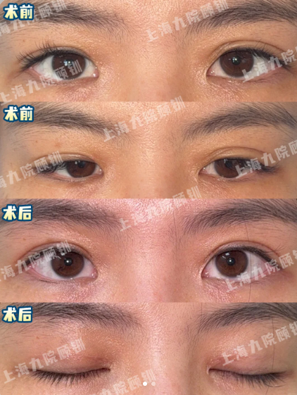 2026上海九院双眼皮修复医生顾钏、金锐、周显玉、王俊芳、马昊眼修复谁更厉害？