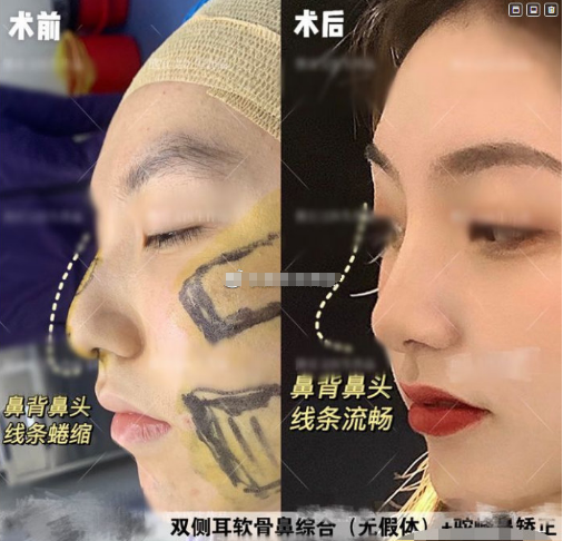 西安西京医院张曦做鼻子技术怎么样？