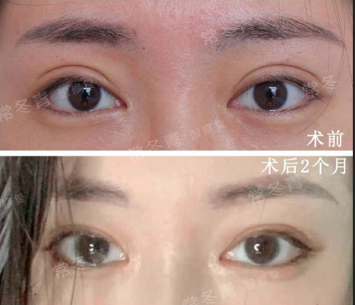 北京常冬青修复双眼皮技术到底怎么样？