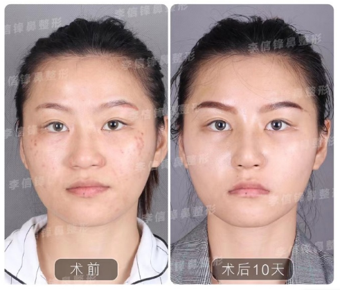 深圳李信锋做鼻子技术审美靠谱吗？