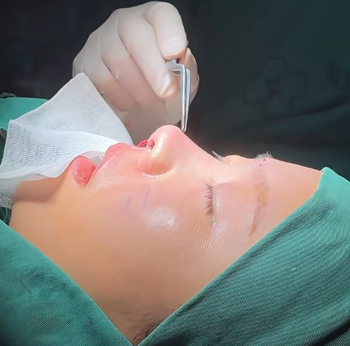 南京做鼻修复的专家曹海峰和陈天杰谁隆鼻修复技术好？