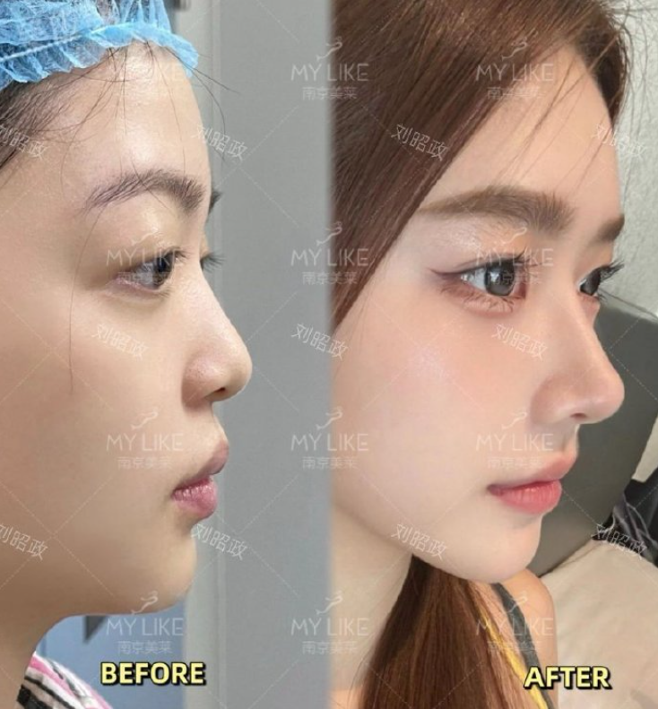 南京做隆鼻的医生刘昭政和林金德哪个修复技术好？