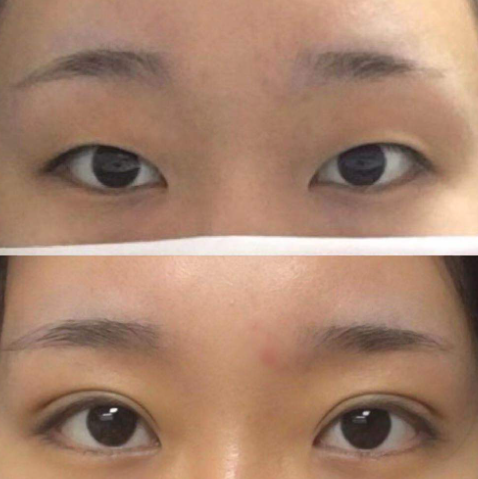 大连赵穆欣和李研哪个医生割双眼皮口碑好？赵穆欣李研做双眼皮预约咨询电话