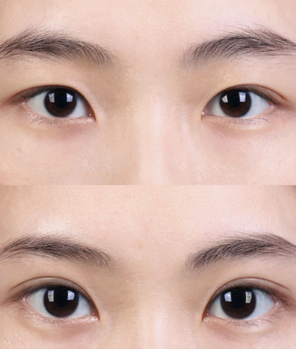 大连做双眼皮的专家王洁晴和李研哪个医生做双眼皮好？