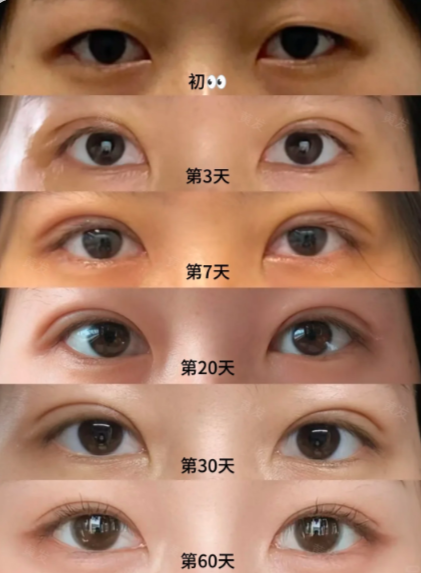 南京做双眼皮医生哪个好？黄发、朱喆辰、王金明、刘宁谁做双眼皮技术更厉害？