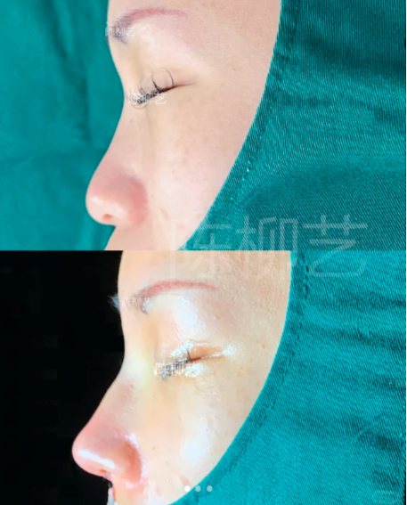 苏州隆鼻陈柳艺和张亮哪个医生口碑好？陈柳艺张亮做鼻子技术谁好？