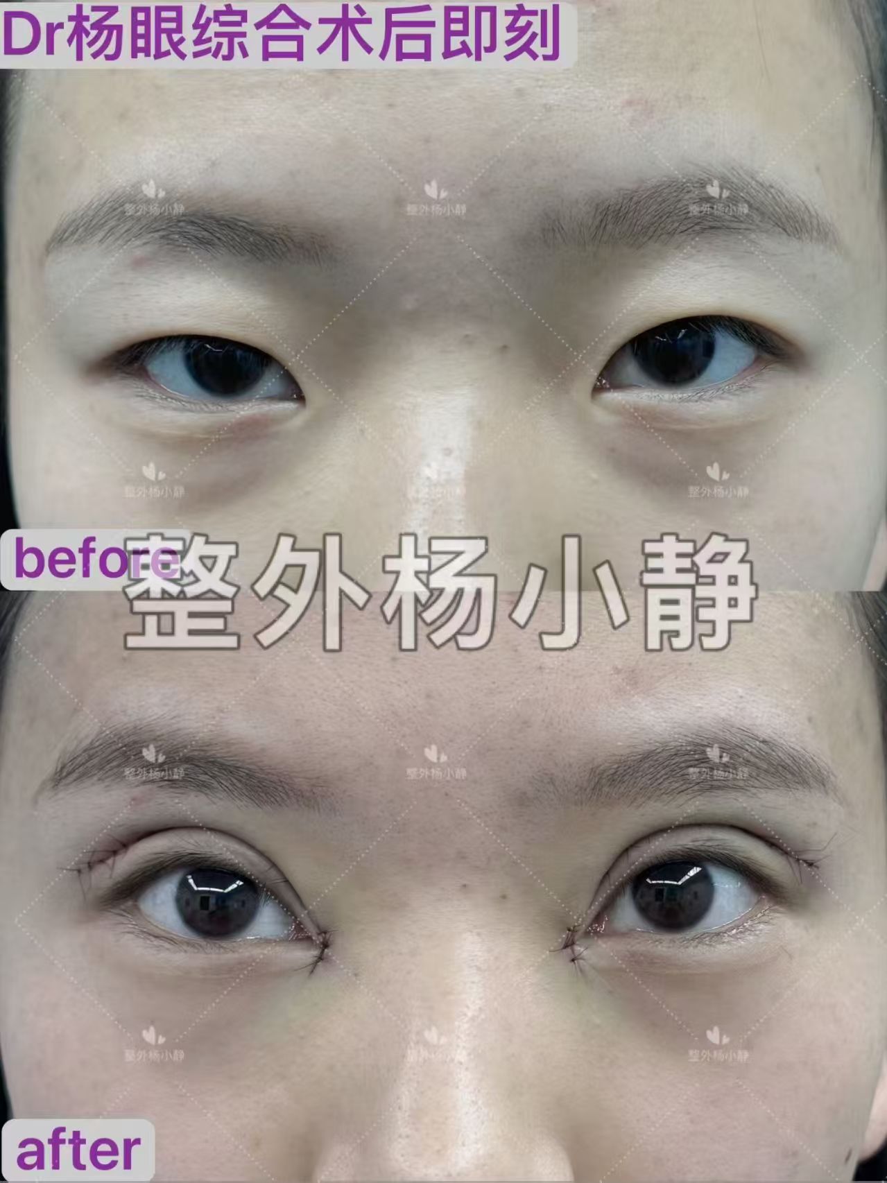 太原割双眼皮医生哪个好？杨小静和张慧华做双眼皮咋样？