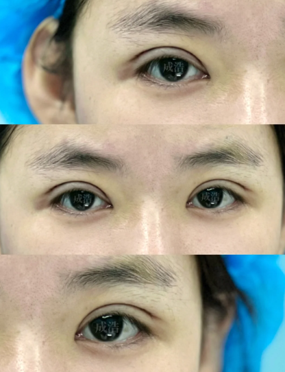 台州成浩和郑金满哪个医生割双眼皮好？成浩和郑金满做双眼皮预约咨询电话