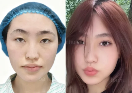 呼和浩特双眼皮医生白虎和裴大伟做双眼皮技术更推荐谁？