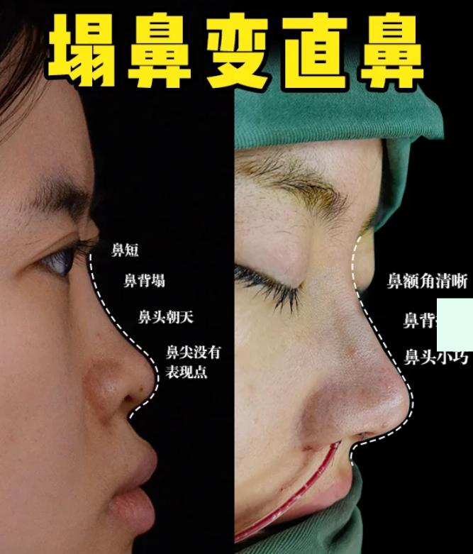 合肥隆鼻医生赵士俊和孙洋哪个技术好？赵士俊孙洋做鼻子咨询预约电话