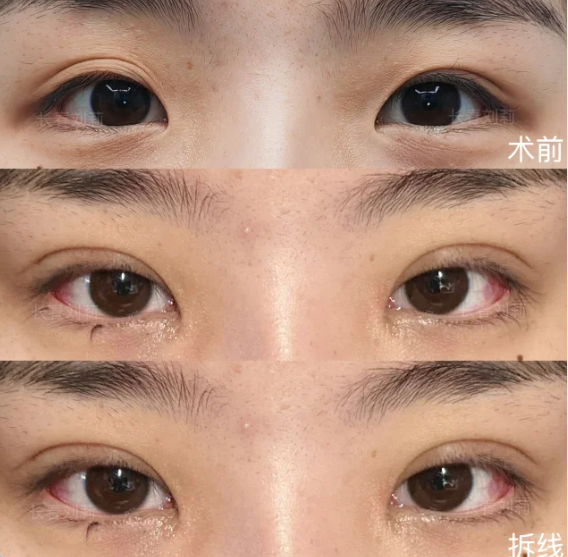 长春割双眼皮专家刘莉和宋斌哪个医生口碑好？刘莉和宋斌双眼皮预约