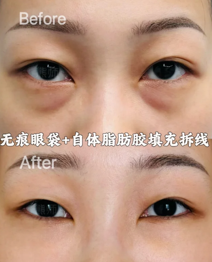 宁波祛眼袋医生熊师和陆欣做去眼袋谁技术口碑更好？