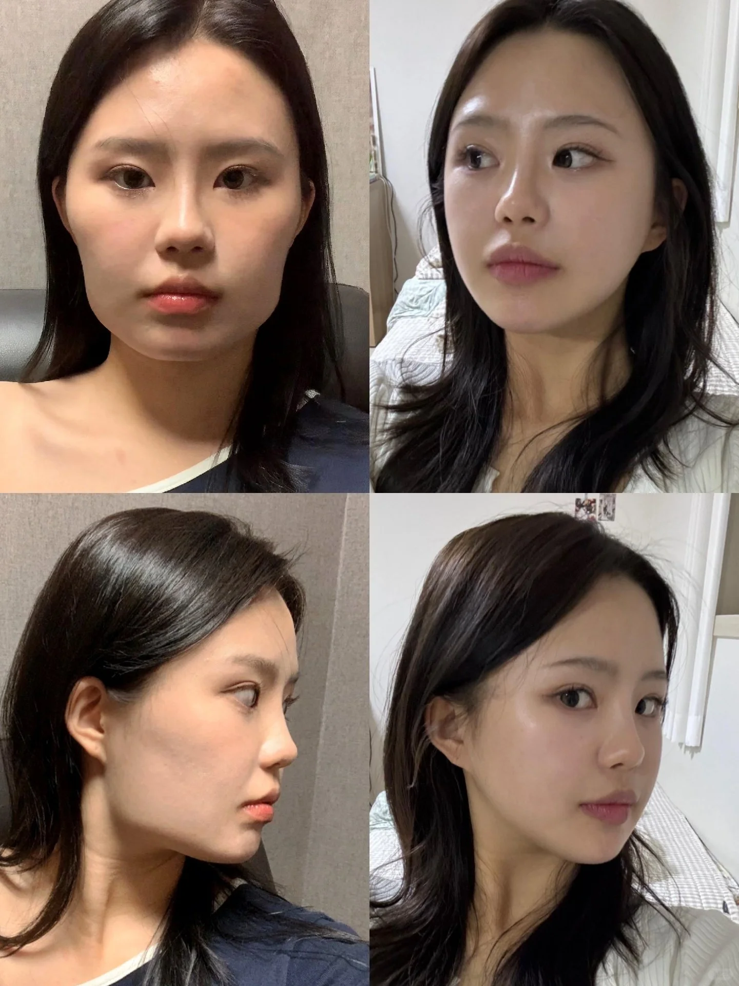 重庆朱乐林和肖林哪个医生做磨骨好？朱乐林和肖林磨骨改脸型预约电话