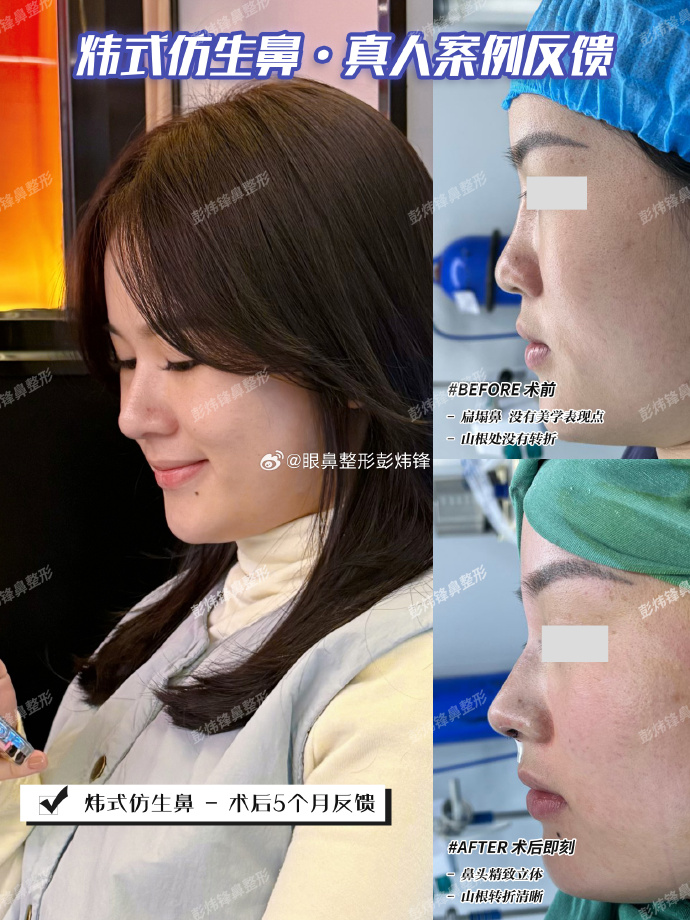 长沙彭炜锋鼻子做的怎么样？彭炜锋隆鼻咨询预约