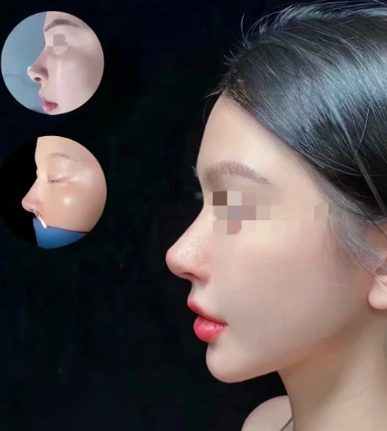 福州隆鼻哪个医生比较好？林峰和张潮哪个做鼻子效果更好？