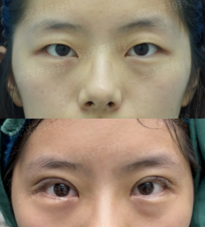 武汉双眼皮严玲玲和曹玮哪个医生技术好？严玲玲和曹玮做双眼皮谁更厉害？