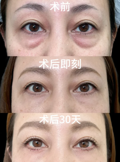 福州郑厚兵和杨宇哪个医生祛眼袋好？郑厚兵和杨宇做祛眼袋咨询预约电话