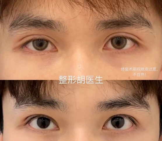 金华做双眼皮哪个医生好？胡维君和赵伟割双眼皮哪个好？