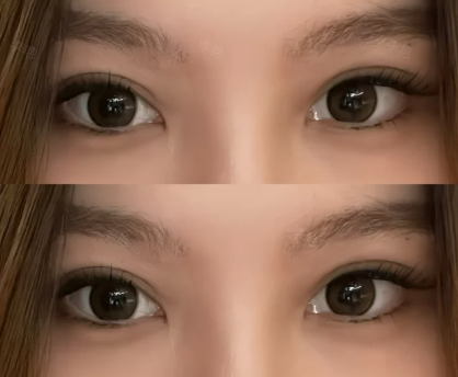 南宁做双眼皮专家李艳和蒙旭昌哪个医生做双眼皮好？李艳和蒙旭昌双眼皮案例谁好？