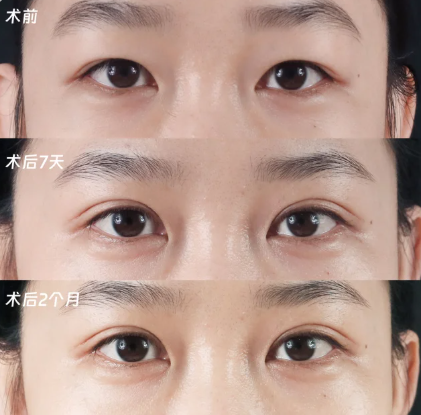 宁波割双眼皮哪个医生好？李晓冬和陈先钱割双眼皮谁更好？