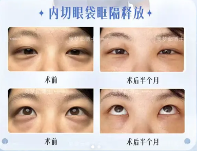 贵阳庞梦茹和安宁哪个祛眼袋技术好？庞梦茹和安宁祛眼袋怎么预约？