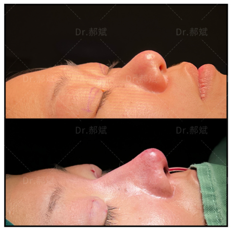 北京隆鼻医生郝斌鼻子做的怎么样？郝斌隆鼻费用多少钱？