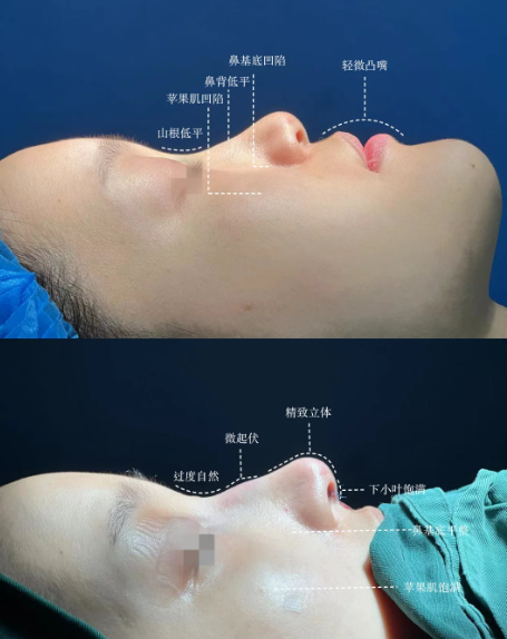 北京八大处张旭龙做隆鼻技术怎么样？张旭龙隆鼻预约咨询电话