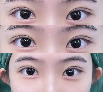 北京做双眼皮专家胡彬和吴焱秋哪个医生割双眼皮技术好？