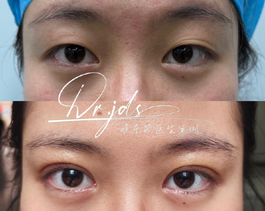 北京姬东硕和宗宪磊哪个做双眼皮好？姬东硕和宗宪磊割双眼皮预约咨询电话