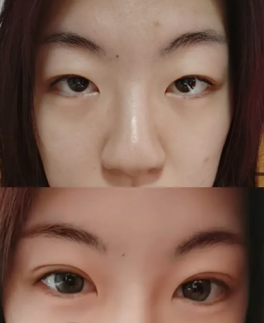 北京割双眼皮八大处林琳和卢建建哪个医生割双眼皮好？