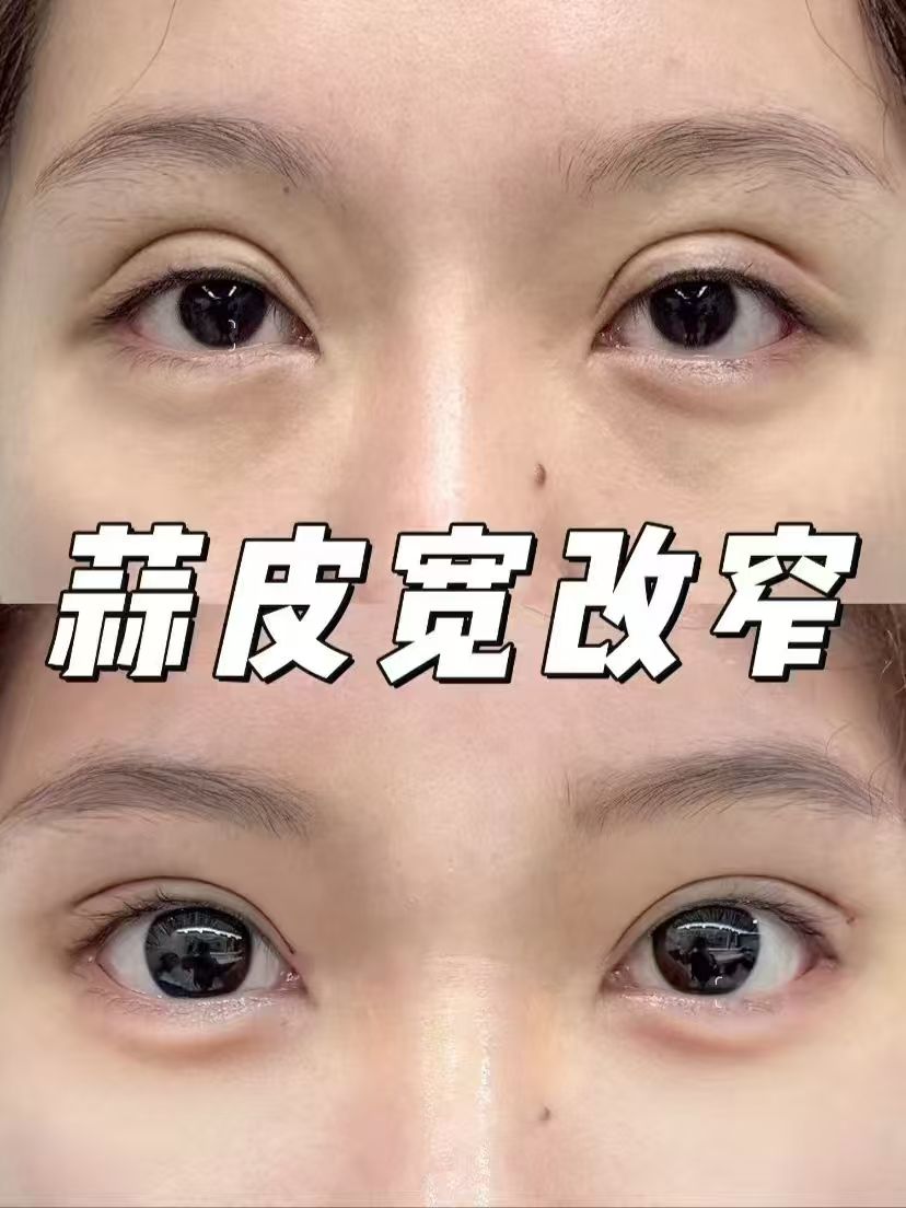 上海瑞格刘平、张楚、杨海平哪个医生做双眼皮修复好？